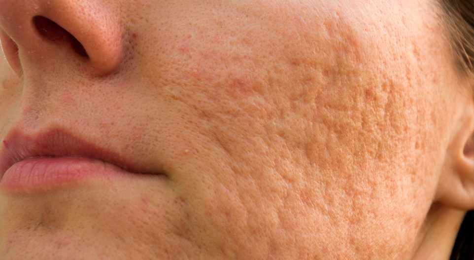 Avanços no tratamento da acne tornam-se mais acessíveis nas clínicas de dermatologia